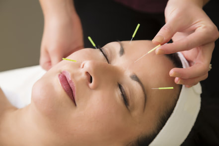 Picture of woman's face with Acupunture needles demonstrating what facial acupuncture looks like